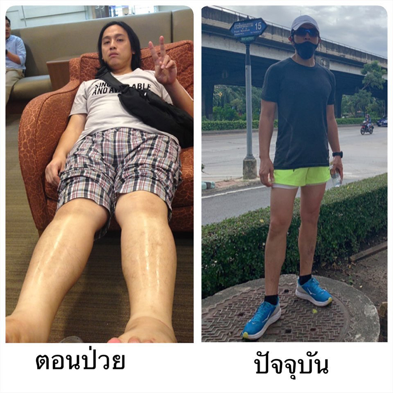 ตุ๊กตา อุบลวรรณ ชิน ชินสุเวท โรคโปรตีนรั่วในปัสสาวะ