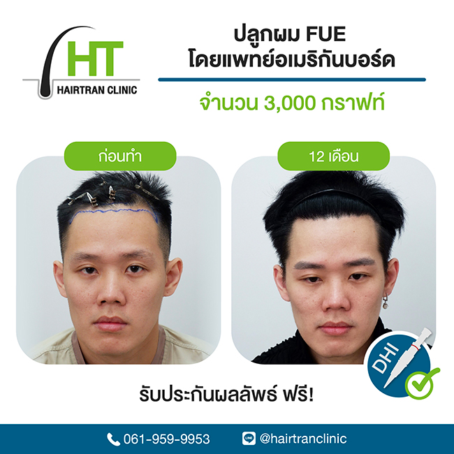 สร้างชื่อ ! หมอแพตตี้ จาก Hairtran Clinic คว้าคะแนนสอบปลูกผมอันดับ 1 ของโลก