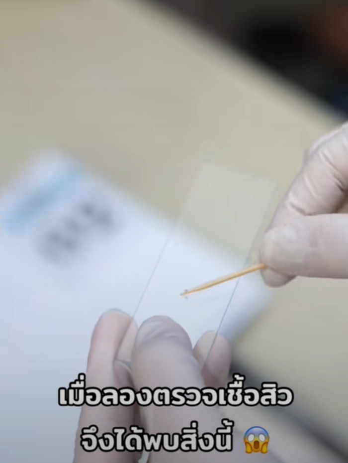 ตรวจเชื้อสิว