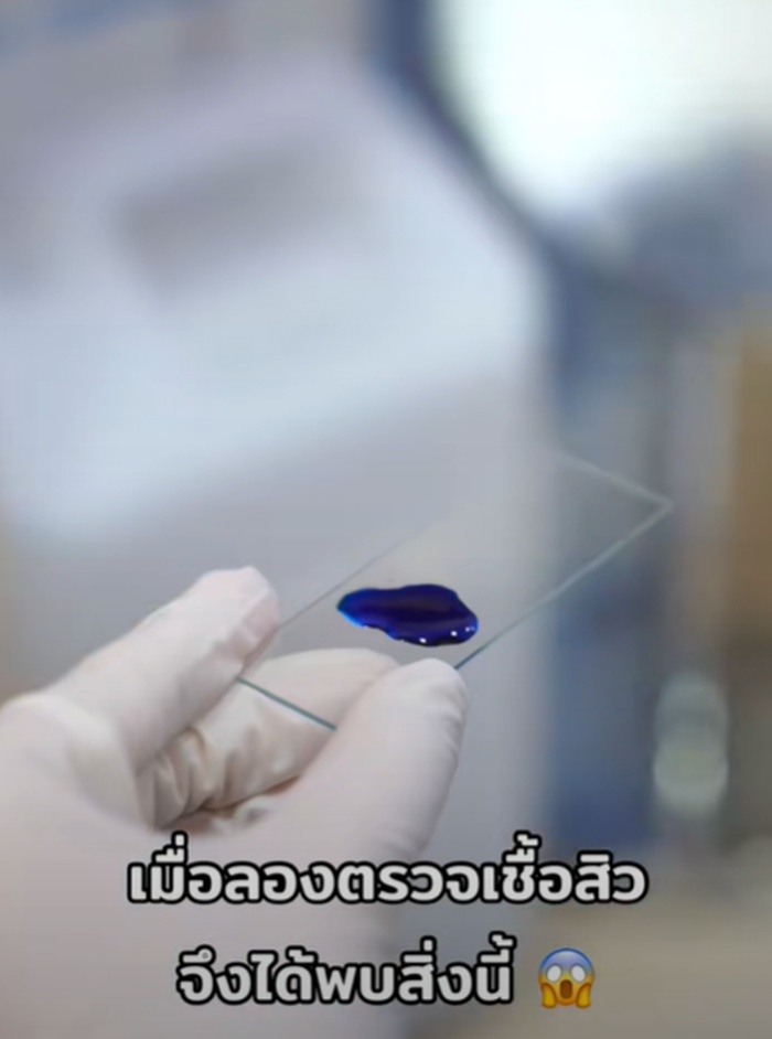 ตรวจเชื้อสิว