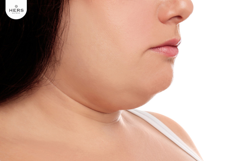 ผ่าตัดเหนียง