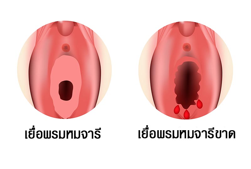 เยื่อพรหมจรรย์ขาด