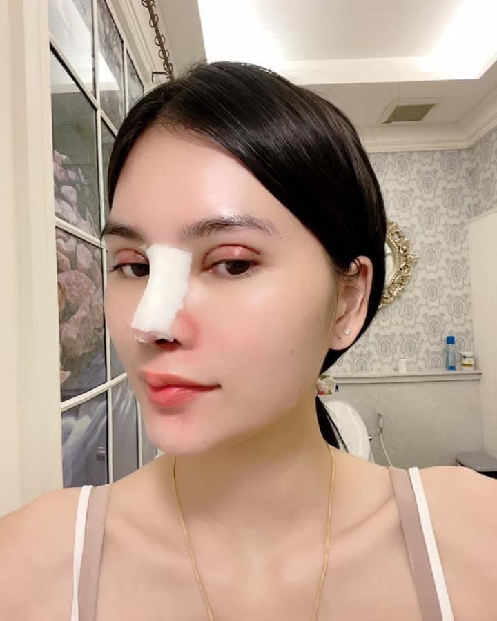 เอ๋ มิรา ศัลยกรรม 