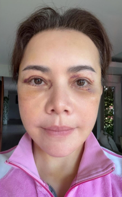 ส่องภาพก่อน-หลังศัลยกรรม หนูแหม่ม สุริวิภา ในวัย 58 สวยเป๊ะย้อนวัยสุด ๆ