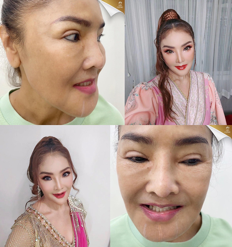 ดาว มยุรี ดาราศัลยกรรม