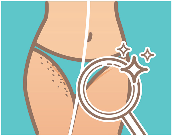 เลเซอร์ขนน้องสาว