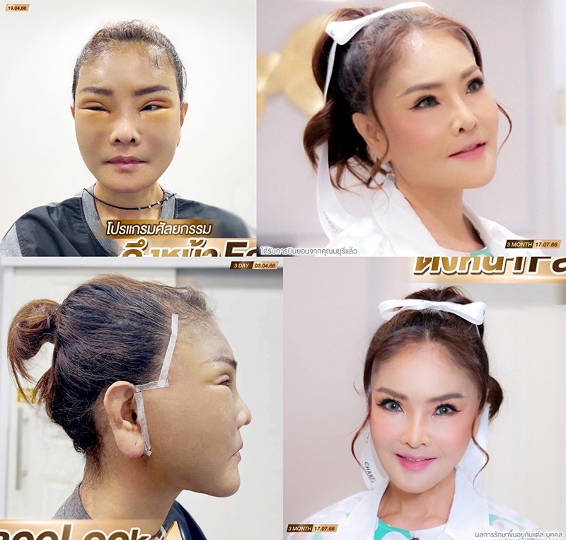 ดาว มยุรี ดาราศัลยกรรม