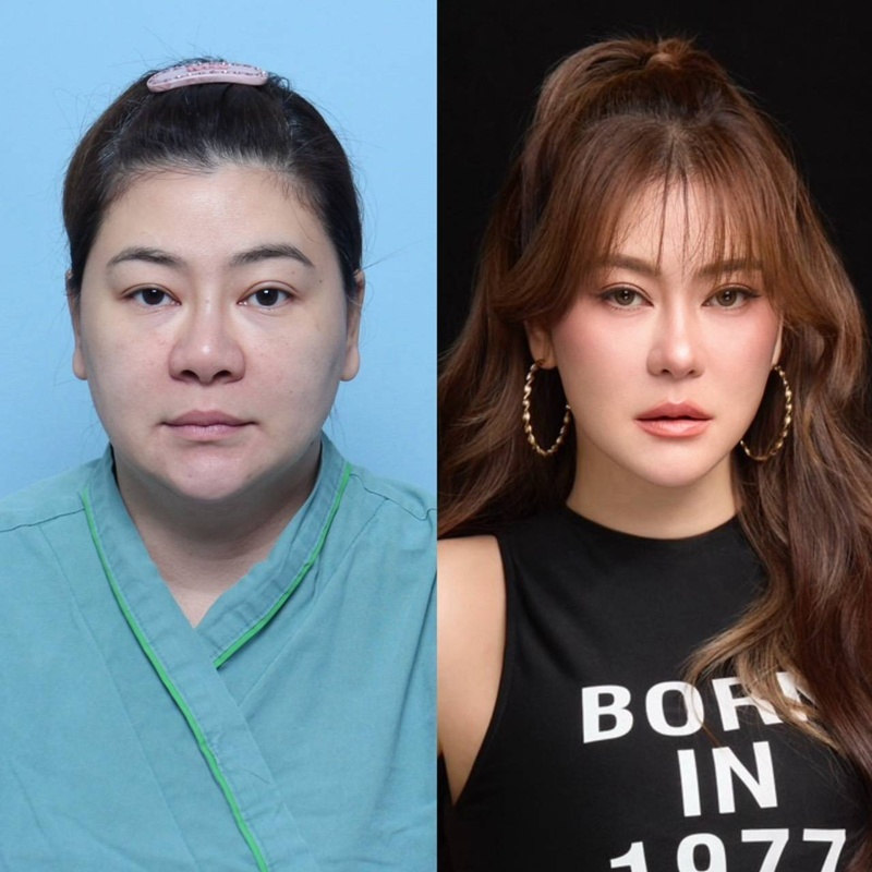 โอ๋ ภัคจีรา ศัลยกรรม