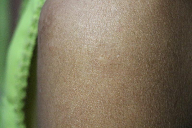 ปลูกฝี