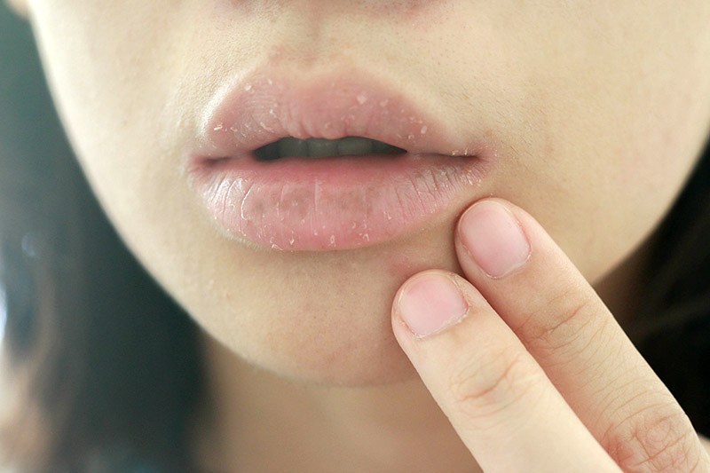 วิธีแก้ริมฝีปากแห้ง
