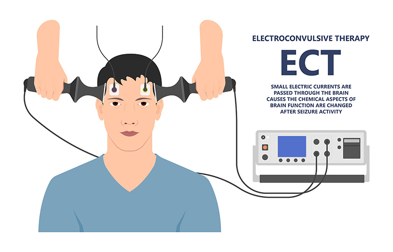 Electroconvulsive Therapy