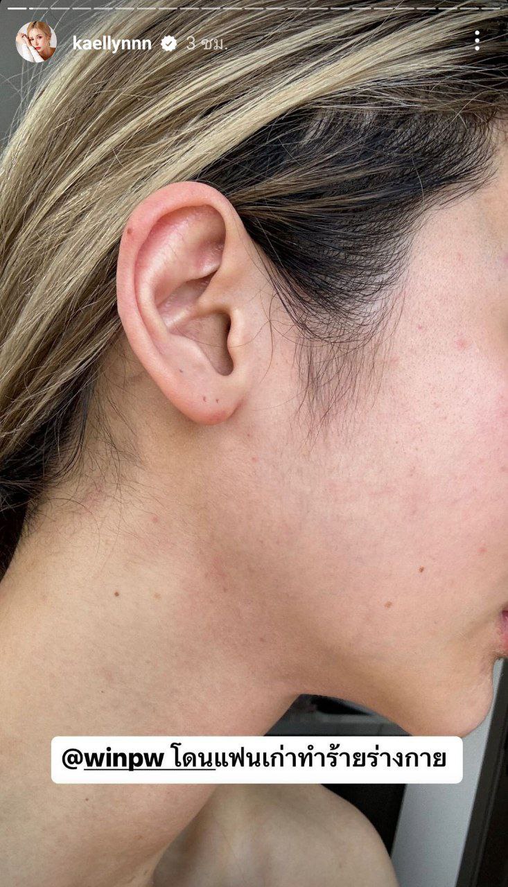 แฟนเก่าทำร้ายร่างกาย