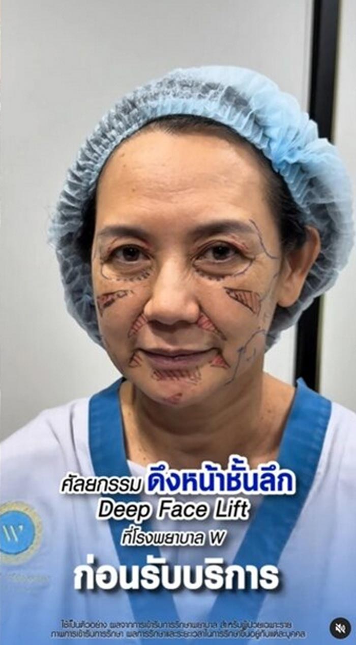 แหม่ม จินตหรา ศัลยกรรม