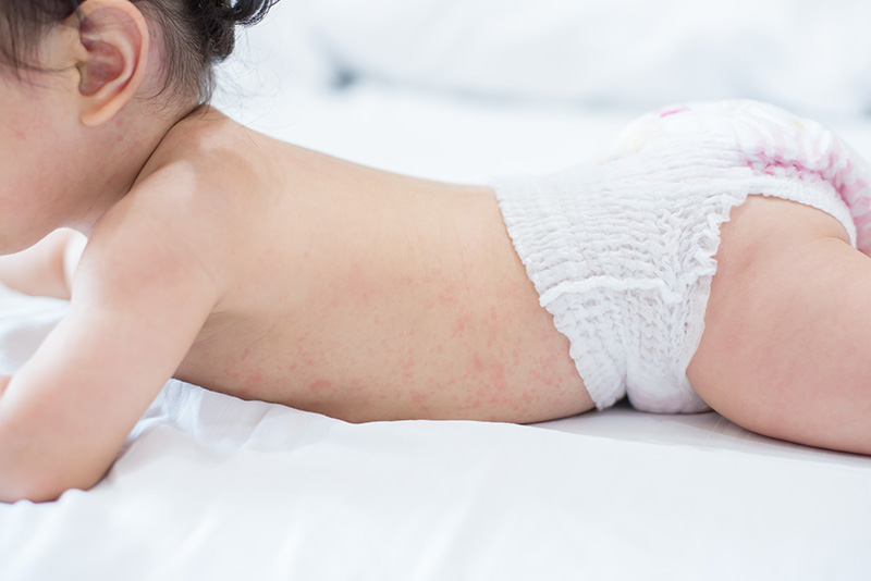 ผื่นคัน