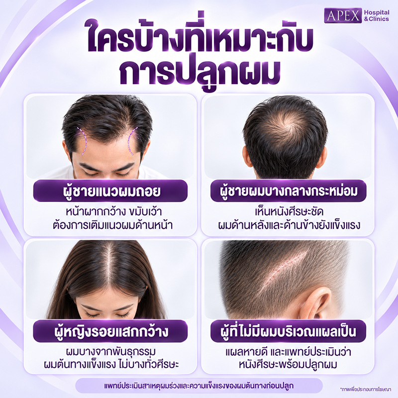 ปลูกผม