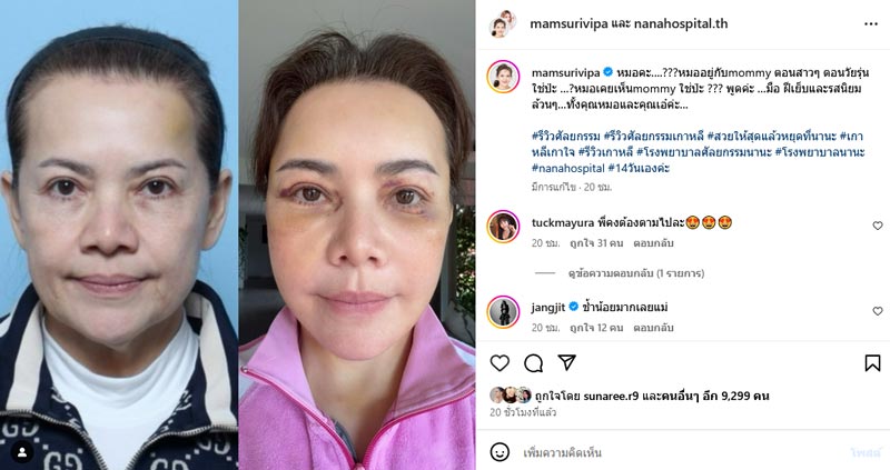 หนูแหม่ม สุริวิภา ศัลยกรรม