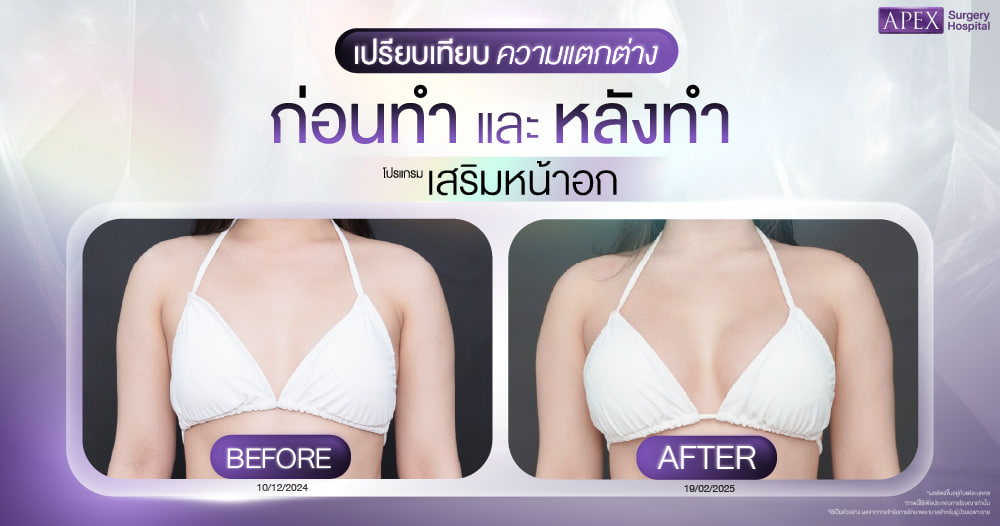 เสริมหน้าอกพักฟื้นกี่วัน