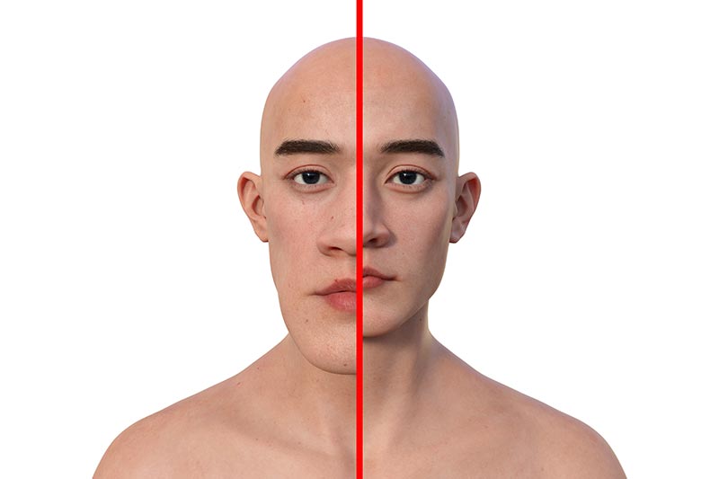 Acromegaly อาการต้องสงสัย