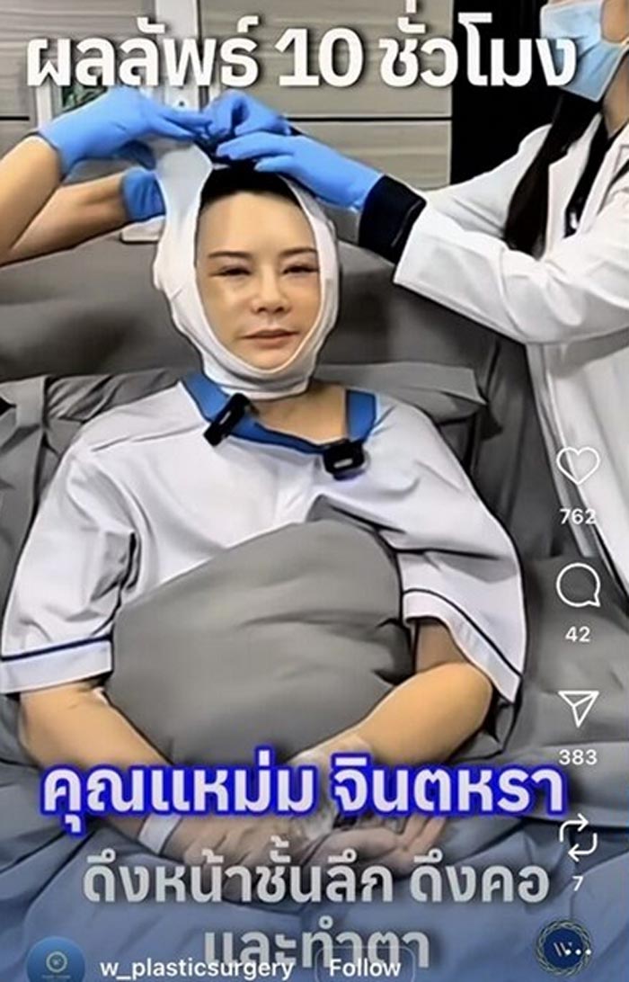 แหม่ม จินตหรา หลังศัลยกรรม