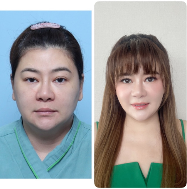 ส่องภาพก่อน-หลังศัลยกรรม โอ๋ ภัคจีรา ในวัย 48 ปี สวยเป๊ะกระชากวัย