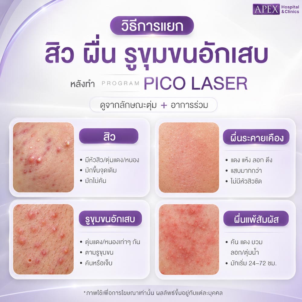 วิธีการแยกสิว ผื่น รูขุมขนอักเสบ หลังทำ Pico Laser