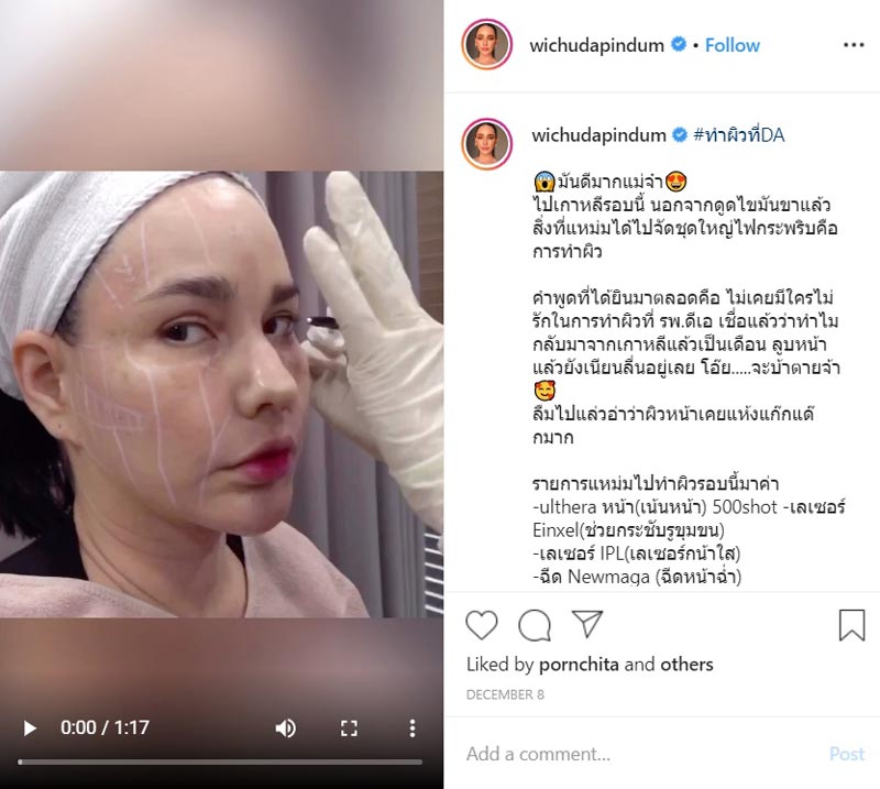แหม่ม วิชุดา ศัลยกรรม