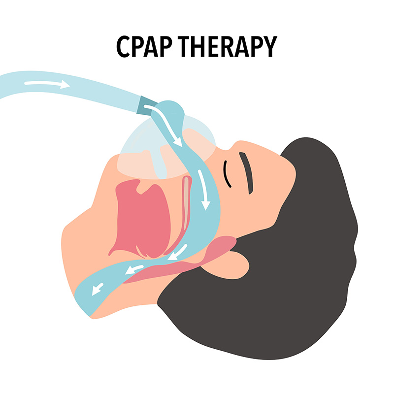 เครื่อง CPAP คืออะไร