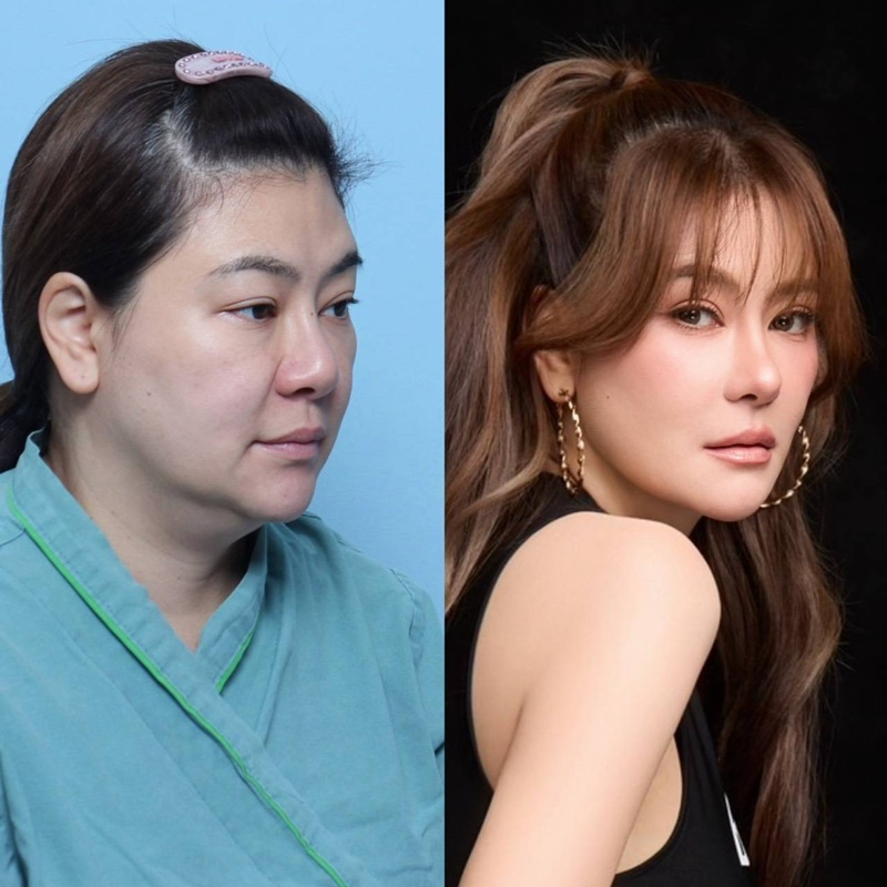 โอ๋ ภัคจีรา ศัลยกรรม