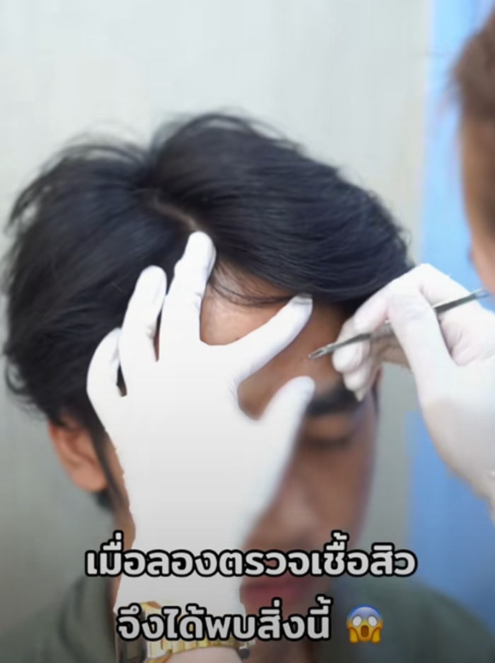 ตรวจเชื้อสิว