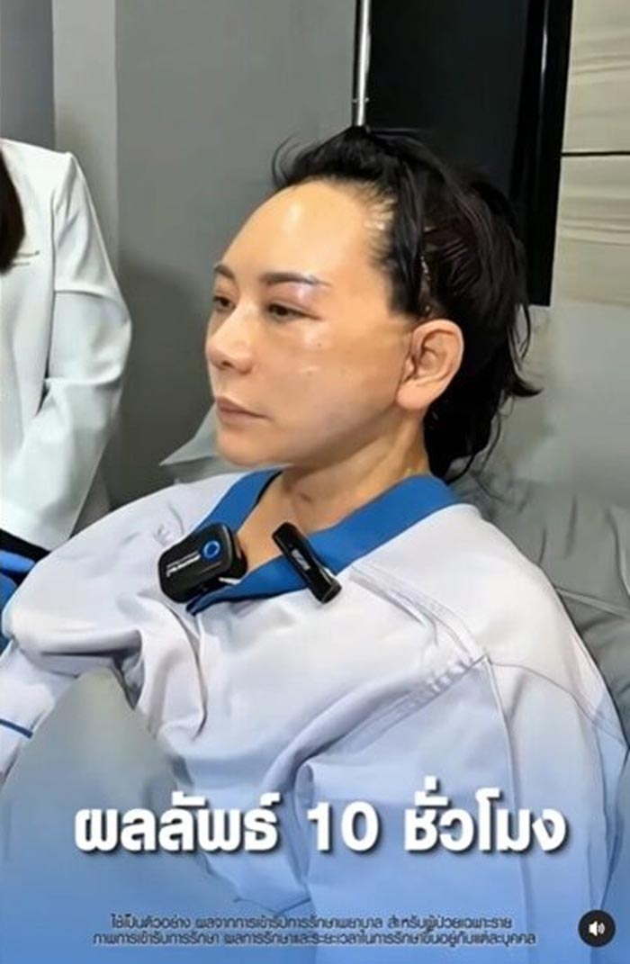 แหม่ม จินตหรา หลังศัลยกรรมหน้า