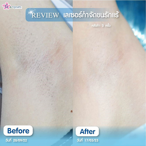 เลเซอร์รักแร้ คลินิกกังนัม