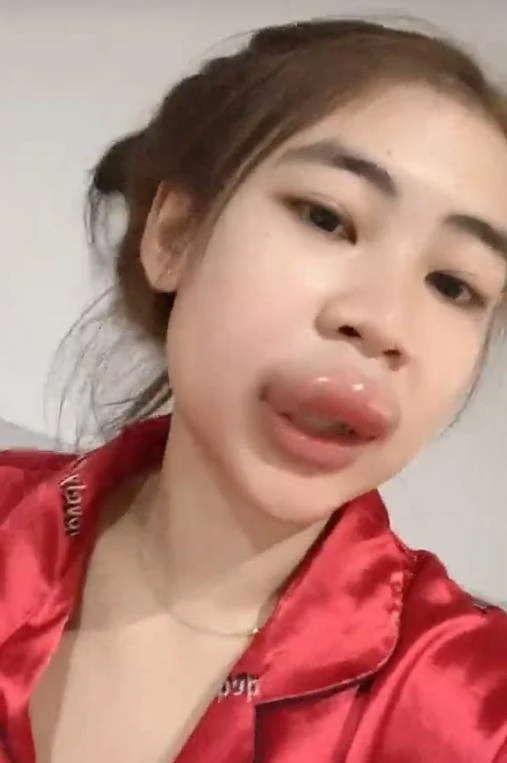 โดนผึ้งต่อย