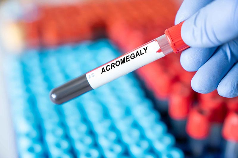 Acromegaly ตรวจยังไง รักษาได้ไหม