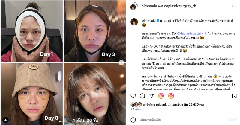 พิมพ์ พิมพ์มาดา เผยสาเหตุทำศัลยกรรมยกหน้าใหม่