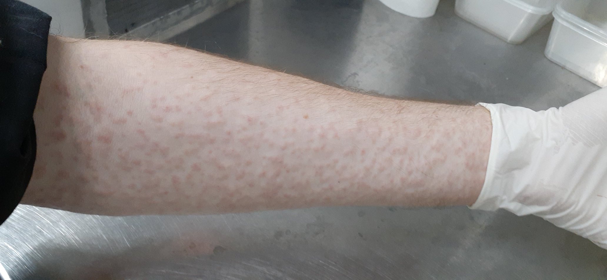 ยุงเกาะเต็มแขน