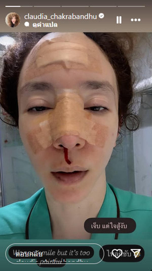 ภาพล่าสุด คลาวเดีย เผยที่มาแผลเย็บ 40 กว่าเข็ม