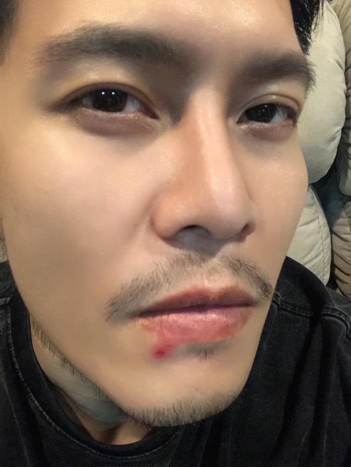 ดิว ภัทรพล ต่อมน้ำเหลืองใต้คางอักเสบ