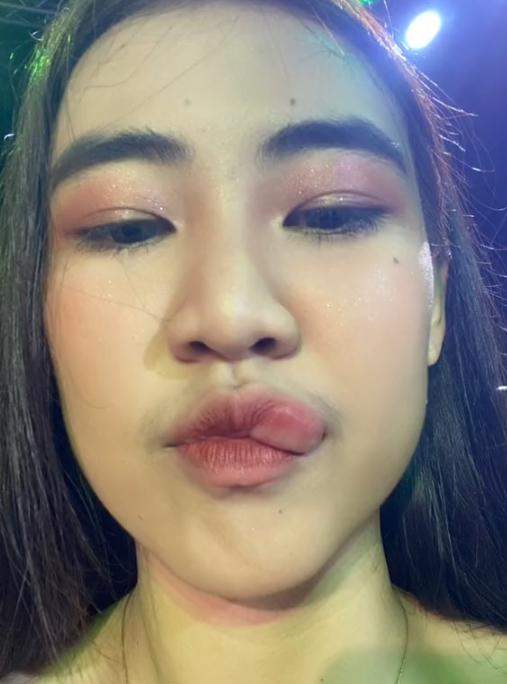 โดนผึ้งต่อย