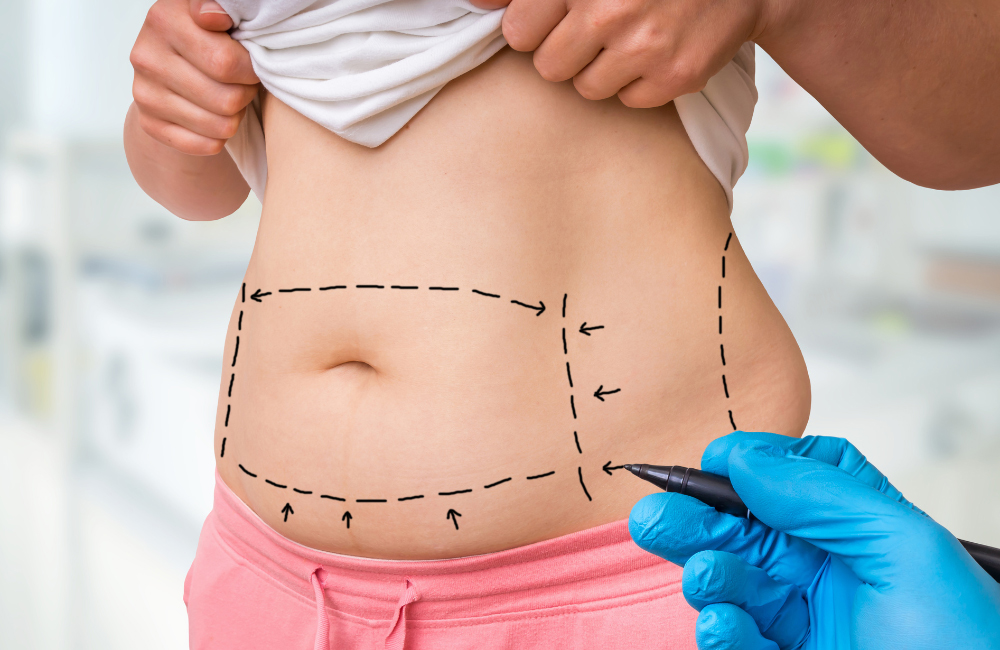 โปรแกรมดูดไขมันเฉพาะจุด