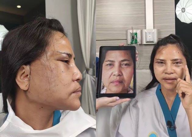 สุนารี ศัลยกรรมหน้า