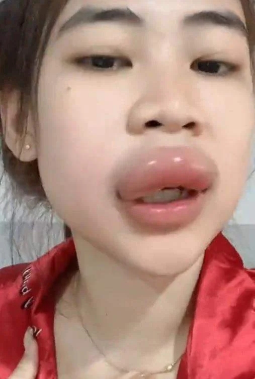 โดนผึ้งต่อย