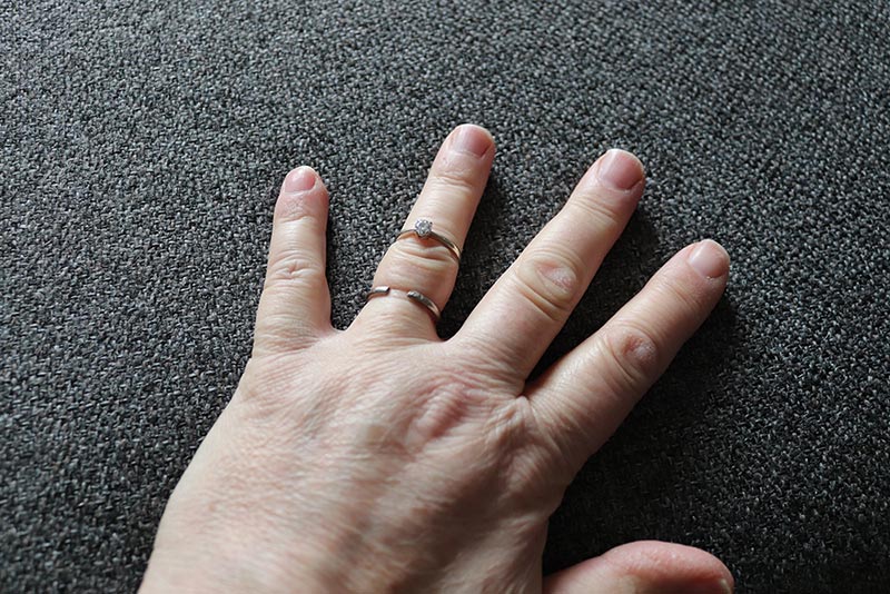 Acromegaly คืออะไร