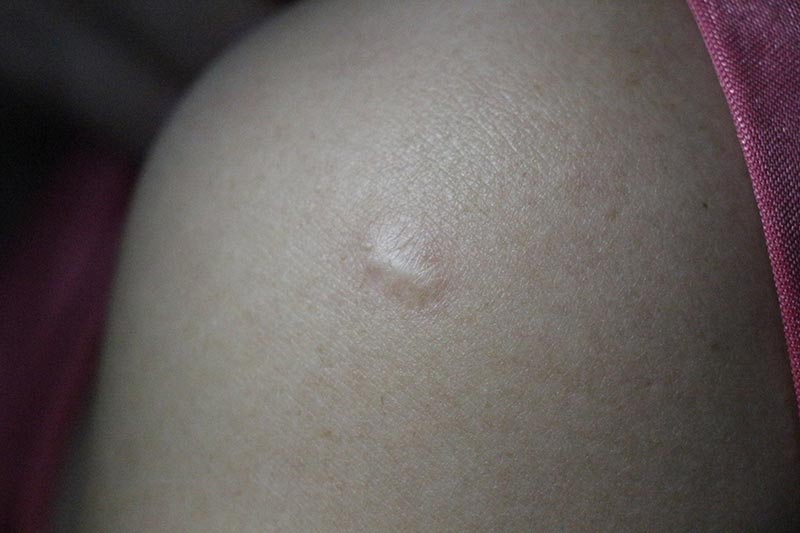 ปลูกฝี