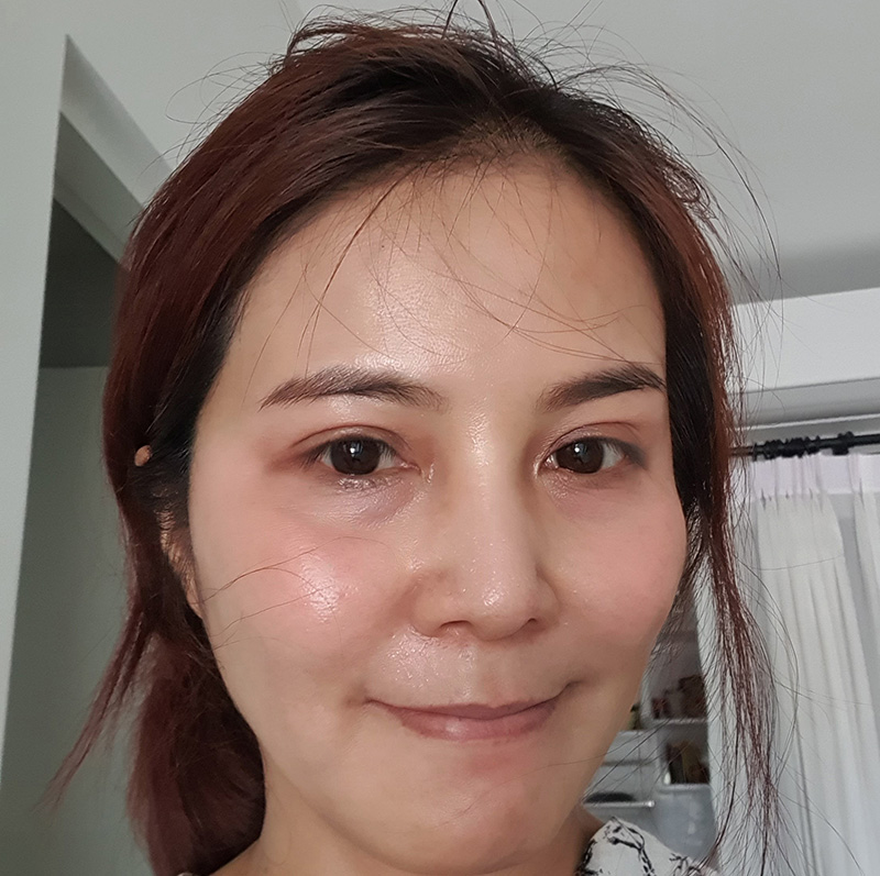 รักษาฝ้าลึก กระ จุดด่างดำ รีวิวสูตรรักษาฝ้าเร่งด่วน