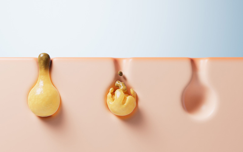 สิวไม่มีหัว