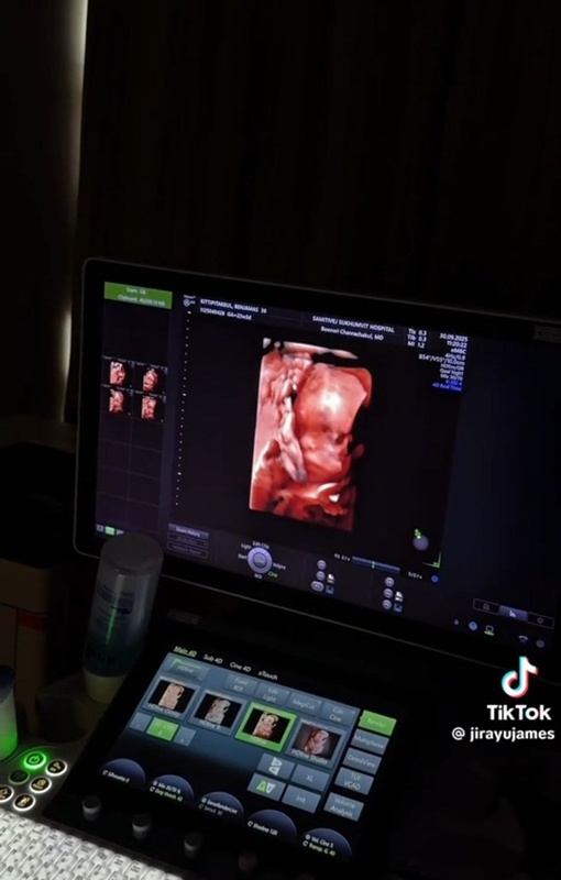 เจมส์ จิรายุ - โฟม เบญจมาศ เผยภาพอัลตราซาวด์เบบี๋อายุ 23 สัปดาห์