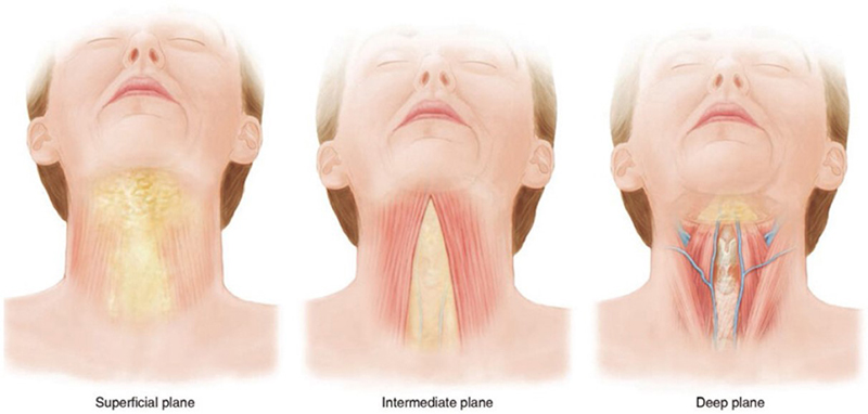 ลดเหนียง แก้คอเหี่ยวด้วย Corset Neck Lift เทคนิคใหม่เพื่อคอเรียวกระชับ