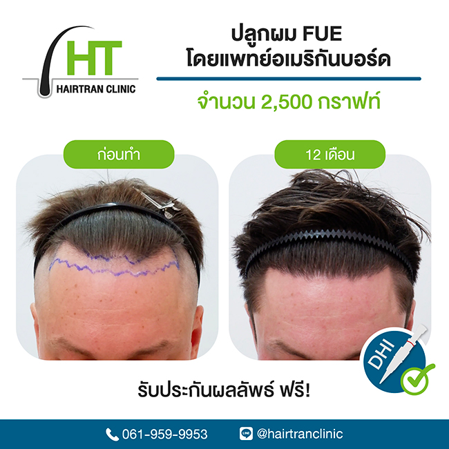 สร้างชื่อ ! หมอแพตตี้ จาก Hairtran Clinic คว้าคะแนนสอบปลูกผมอันดับ 1 ของโลก