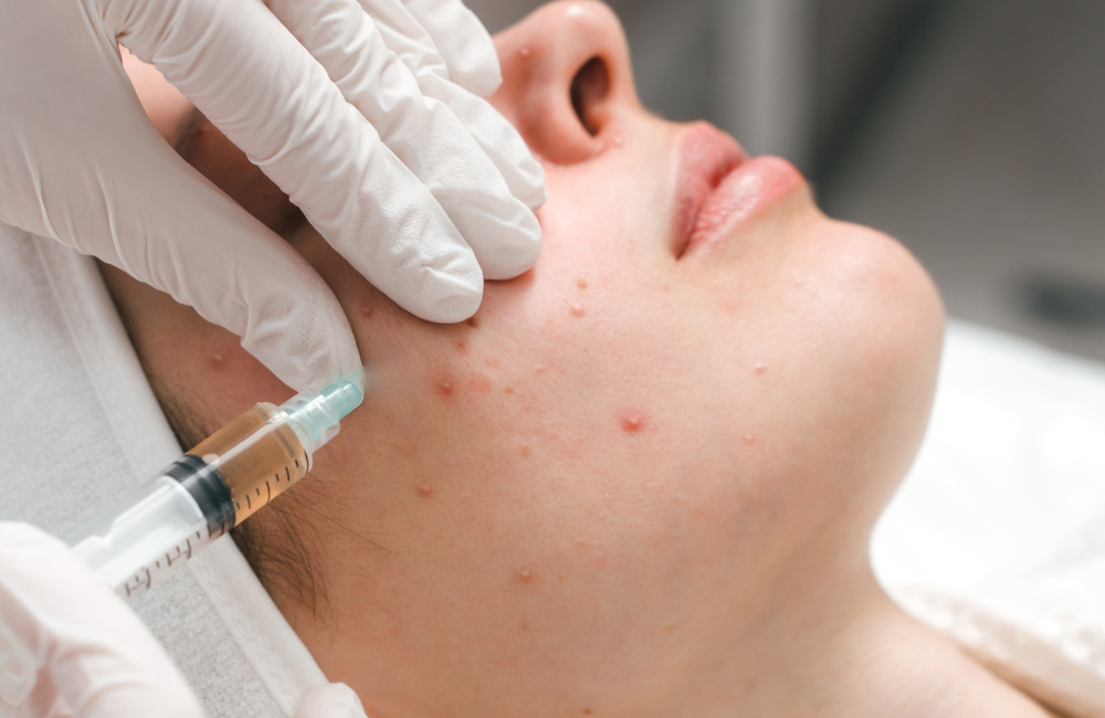 รักษาสิวที่ M Vita Clinic