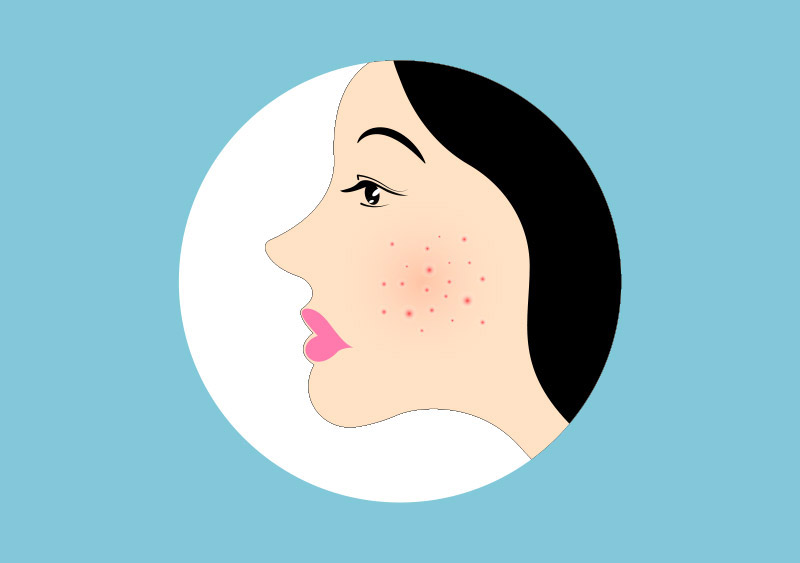 วิธีรักษาสิว